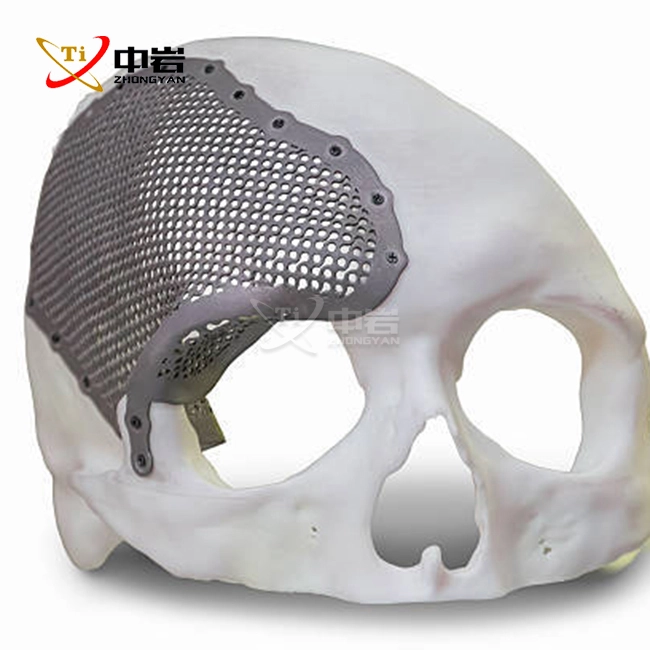 titanium skull plate